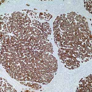 Hepatocyte Specific Antigen (Hep Par-1) (OCH1E5)